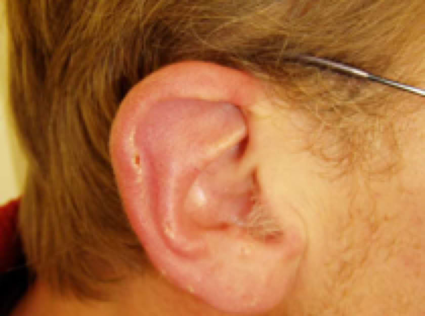Ohr mit Psoriasis