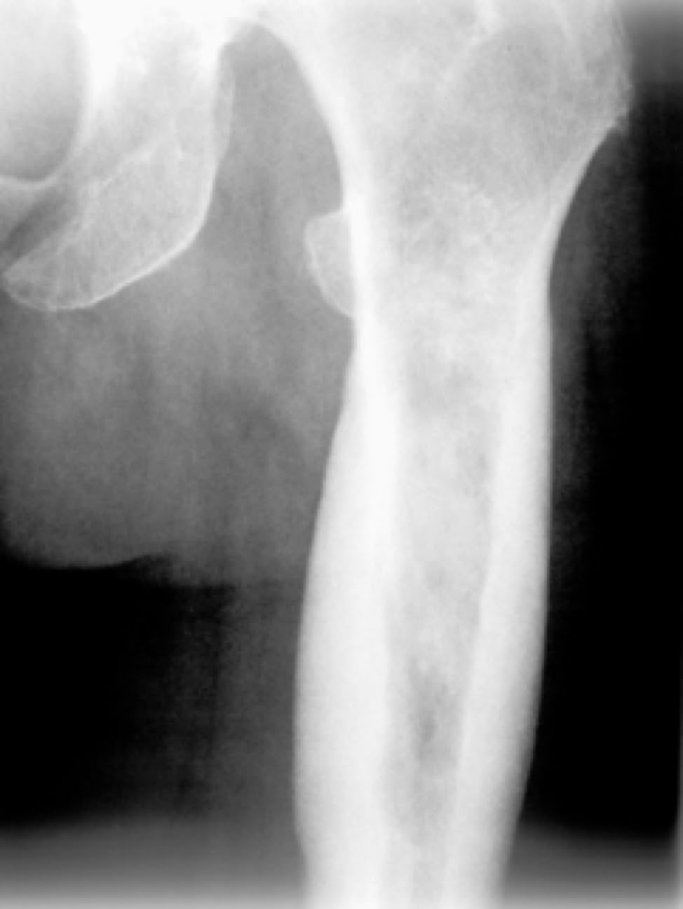 Tumor femur